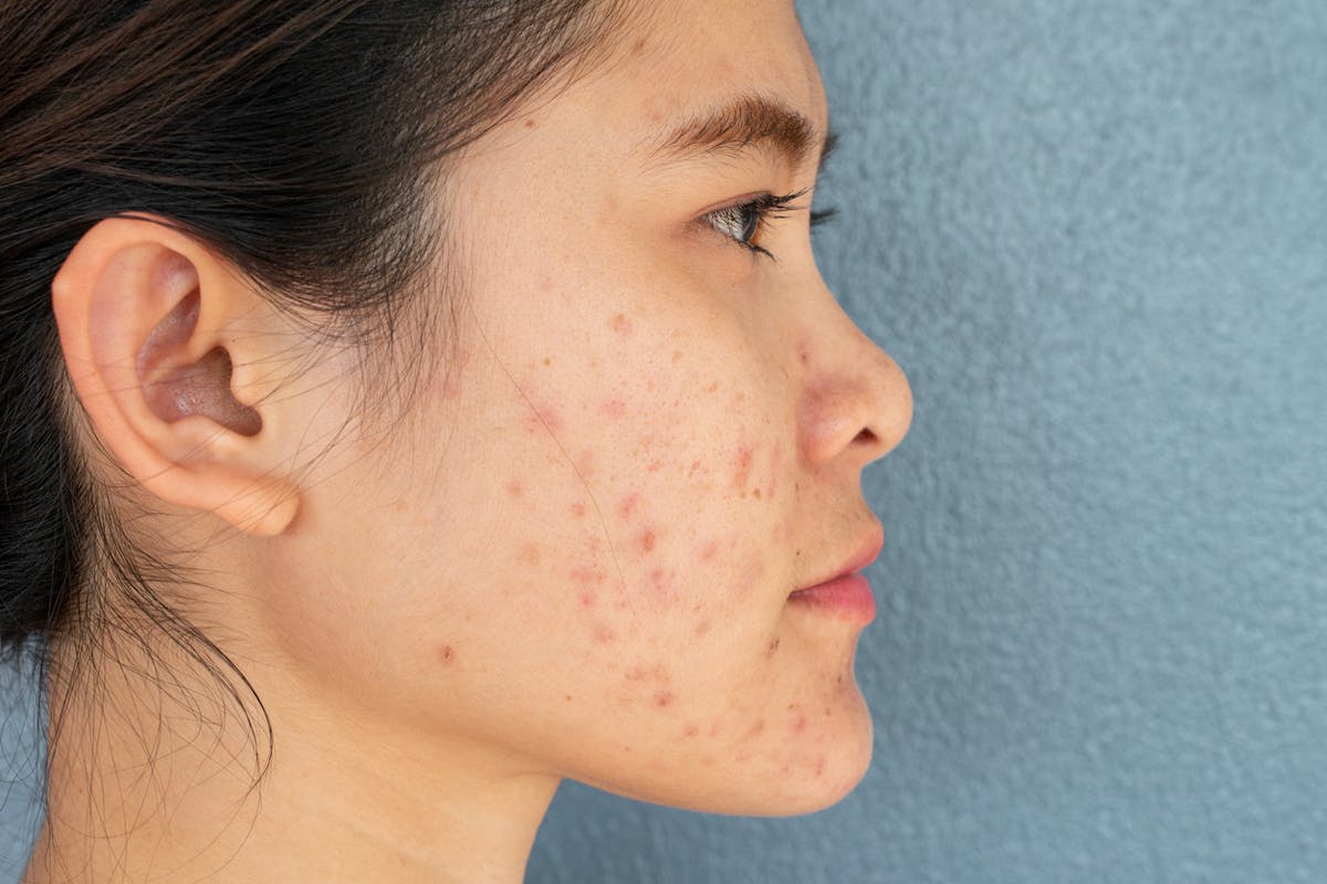 Cicatrices d'acné : comment les enlever ? | Santé Magazine