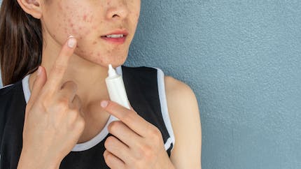5 raisons qui expliquent une poussée d'acné chez l'adulte