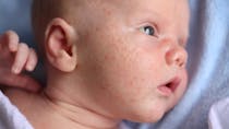 Bébé a de l’acné : que faire ? 
