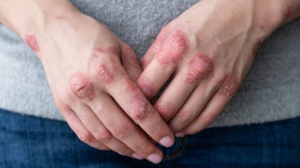 Psoriasis mains-pieds : les femmes fumeuses sont plus à risque