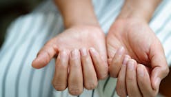 Psoriasis de l’ongle : attention au risque de rhumatisme psoriasique
