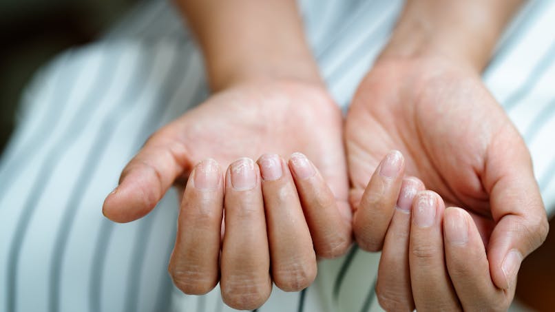 Psoriasis De L Ongle Comment Soigner Le Psoriasis Ungueal Sante Magazine Psoriasis De L Ongle Comment Soigner Le Psoriasis Ungueal Sante Magazine
