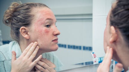 Psoriasis du visage : il est souvent lié à un excès de sébum