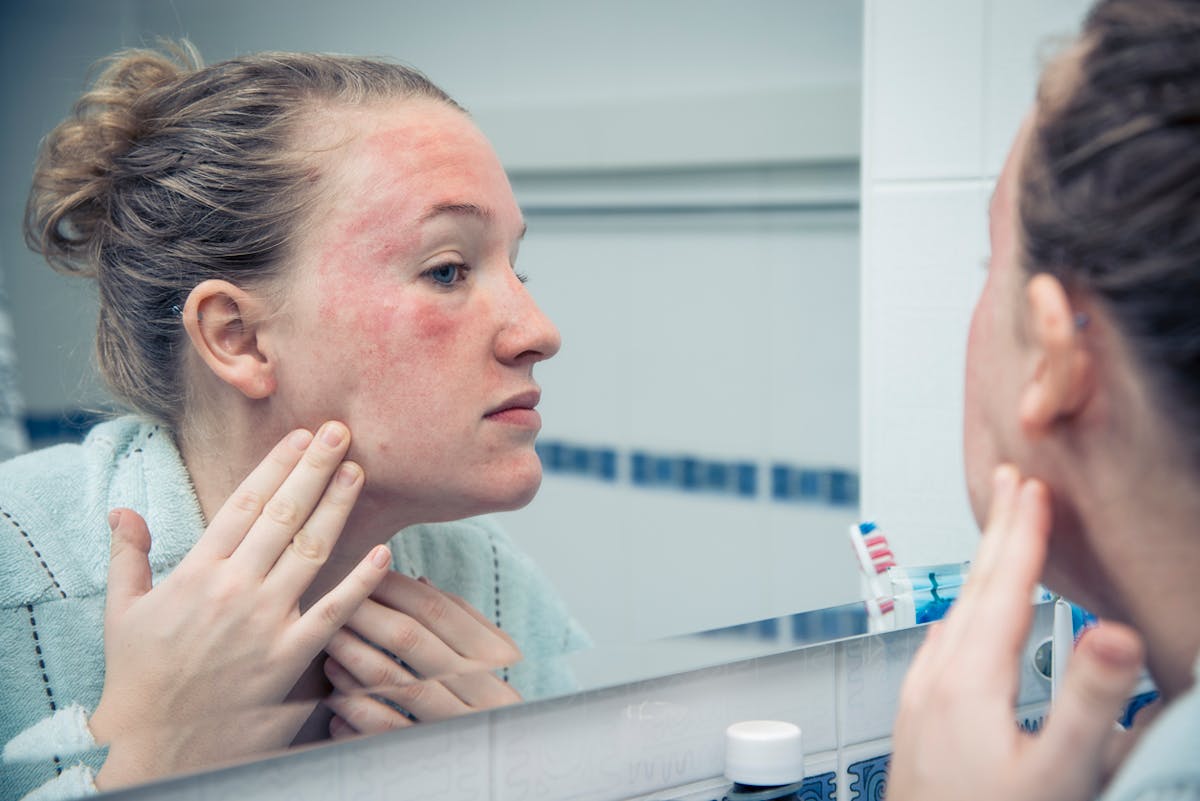 Psoriasis du visage : comment le reconnaître, quel traitement ...