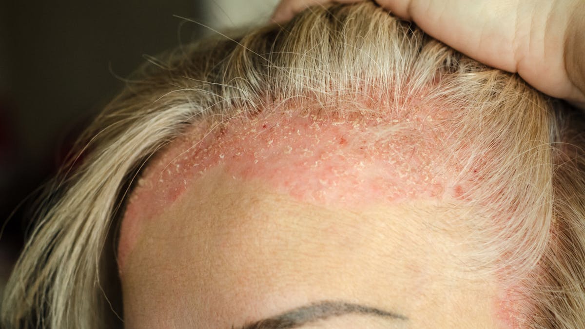 Psoriasis Du Cuir Chevelu Comment Reduire Les Crises Sante Magazine Psoriasis Du Cuir Chevelu Comment Reduire Les Crises Sante Magazine