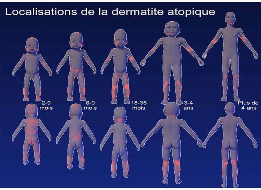 Eczéma ou dermatite atopique chez l'enfant : quelles solutions ...