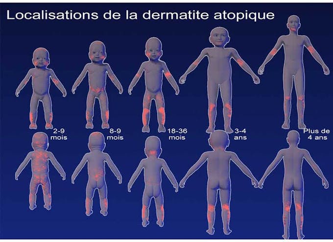 Eczema Chez L Enfant Quelles Solutions Sante Magazine Eczema Chez L Enfant Quelles Solutions Sante Magazine