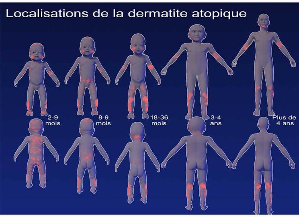 La dermatite atopique de l'adulte - Association Française de l'eczéma