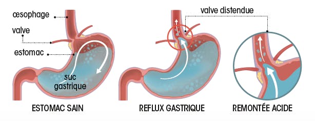 Reflux Gastro Oesophagien Comment Traiter Les Brulures D Estomac Sante Magazine Reflux Gastro Oesophagien Comment Traiter Les Brulures D Estomac Sante Magazine