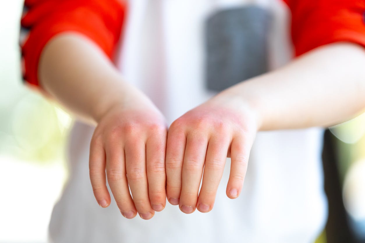 Des Probiotiques Cutanes Permettraient D Ameliorer L Eczema Chez Les Enfants Sante Magazine Des Probiotiques Cutanes Permettraient D Ameliorer L Eczema Chez Les Enfants Sante Magazine