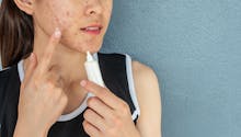 Comment se débarrasser de l’acné kystique ?