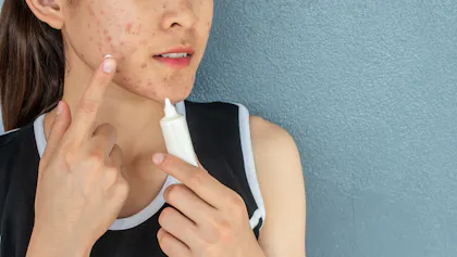 Acné kystique : symptômes, causes, traitements | Santé Magazine