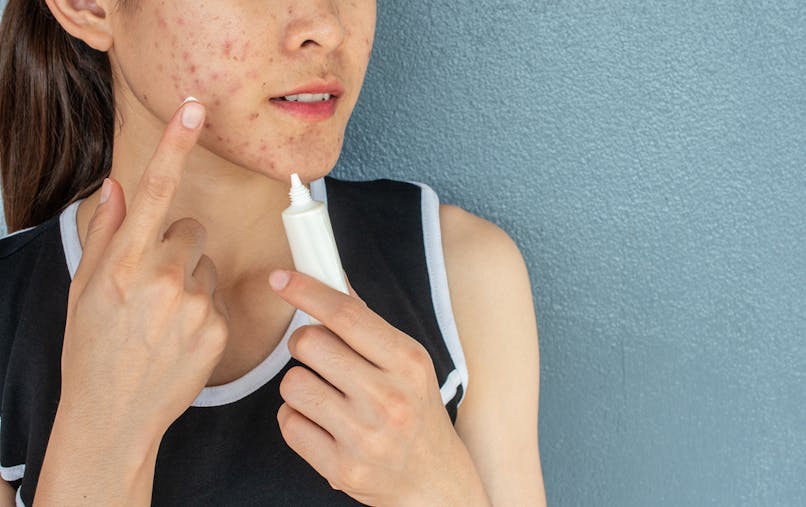 Tout Savoir Sur L Acne Kystique Symptomes Causes Traitements Sante Magazine Tout Savoir Sur L Acne Kystique Symptomes Causes Traitements Sante Magazine