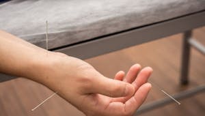 L’acupuncture pour lutter contre le syndrome du canal carpien
