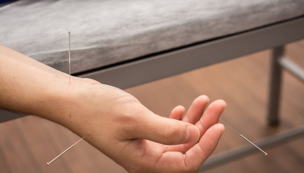 Acupuncture Branche De La Medecine Chinoise Sante Magazine Acupuncture Branche De La Medecine Chinoise Sante Magazine