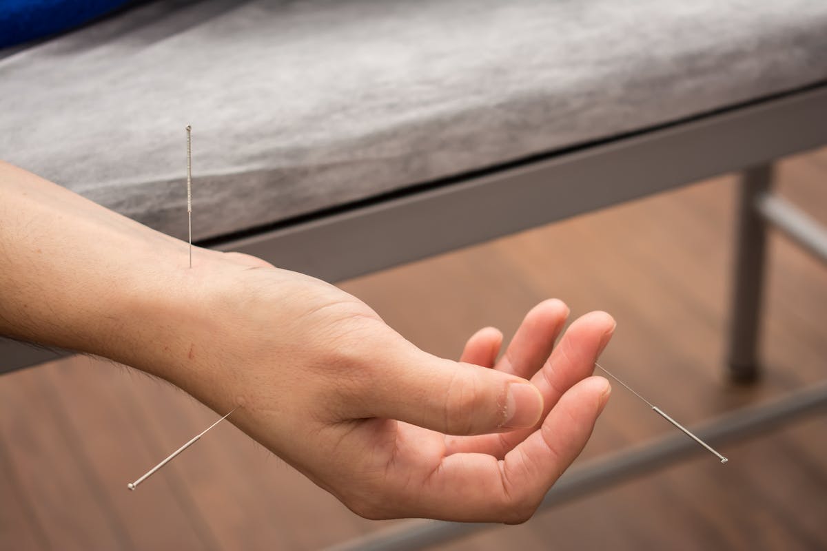 Canal carpien : les bienfaits de l'acupuncture | Santé Magazine