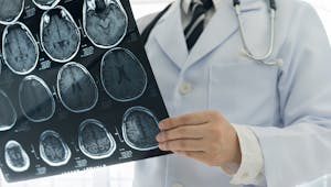 COVID-19 : une étude révèle la présence de lésions dans le cerveau des patients atteints