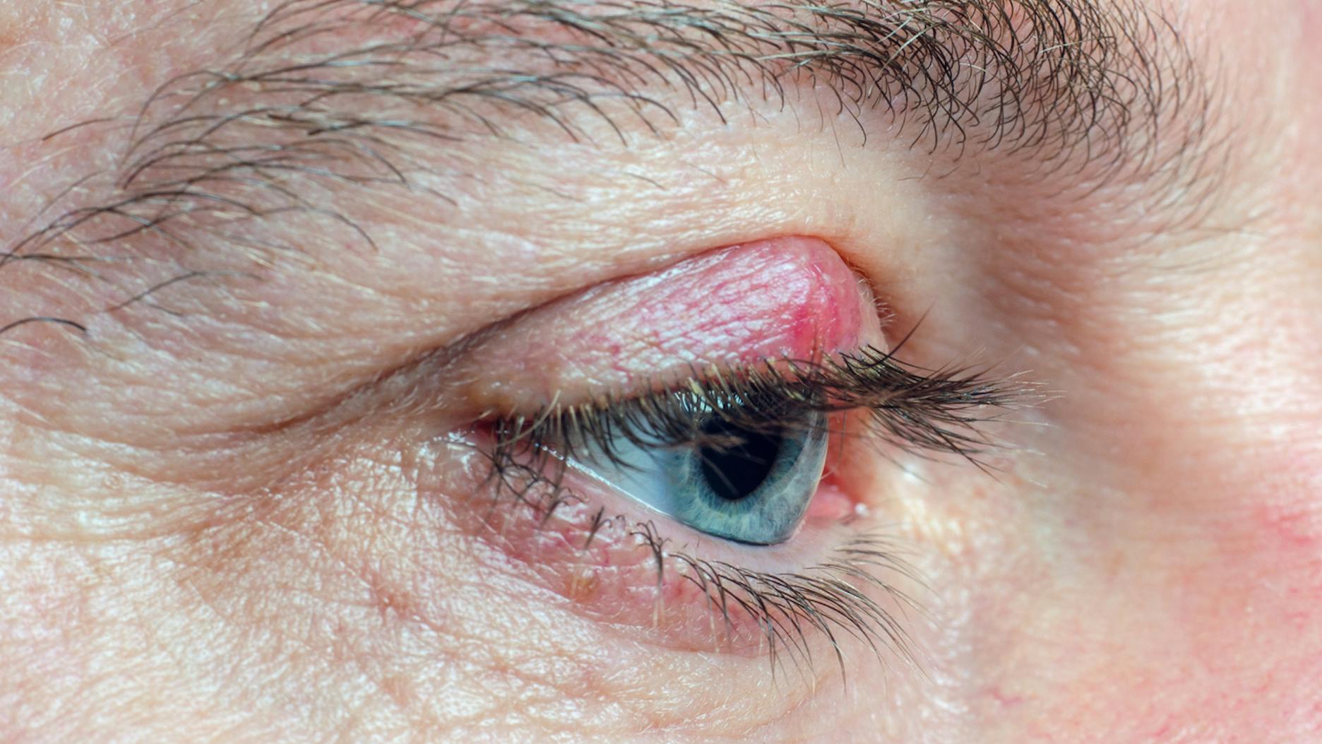 Le chalazion : comment le reconnaître et le soigner ? | Santé Magazine