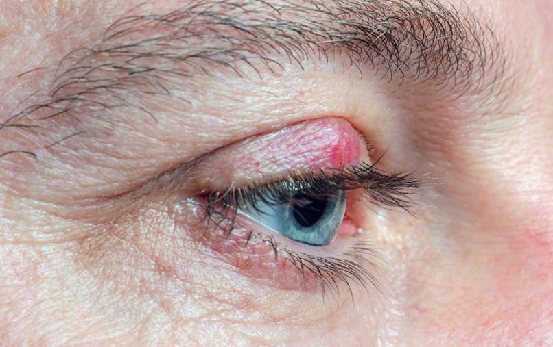 Le Chalazion Comment Le Reconnaitre Et Le Soigner Sante Magazine Le Chalazion Comment Le Reconnaitre Et Le Soigner Sante Magazine