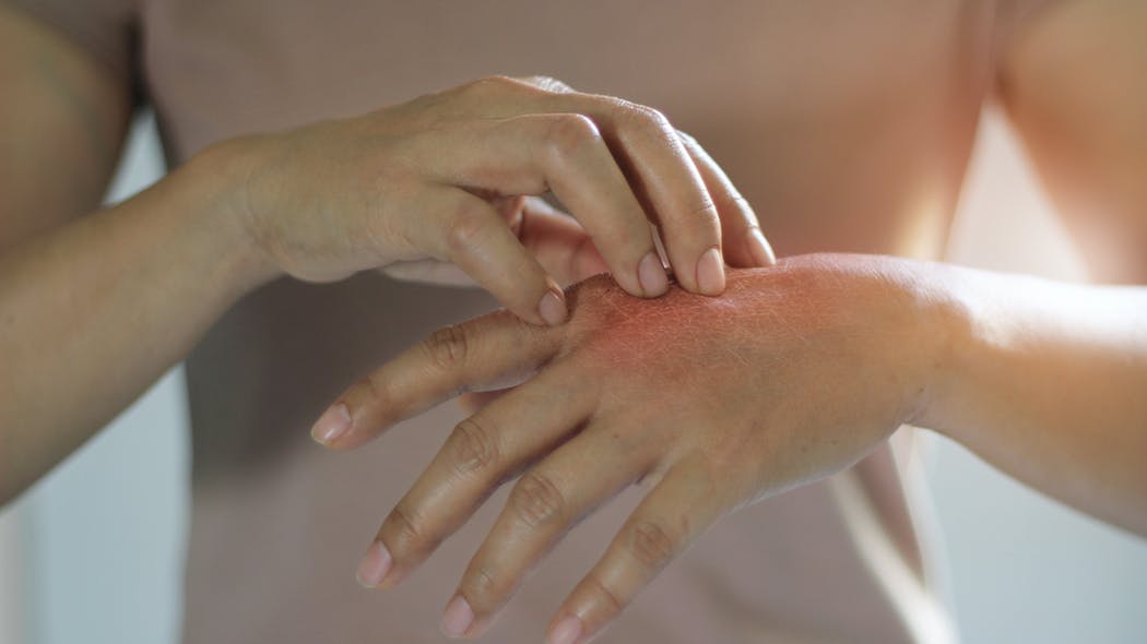 Plaques Rouges Sur Le Corps Sans Demangeaison De Quoi S Agit Il