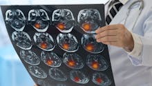 Cancer du cerveau : quels signes ? quelle prise en charge ?