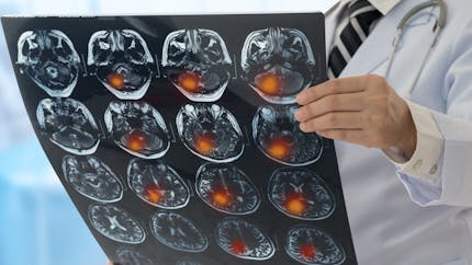 Cancer du cerveau : quels signes ? quelle prise en charge ?