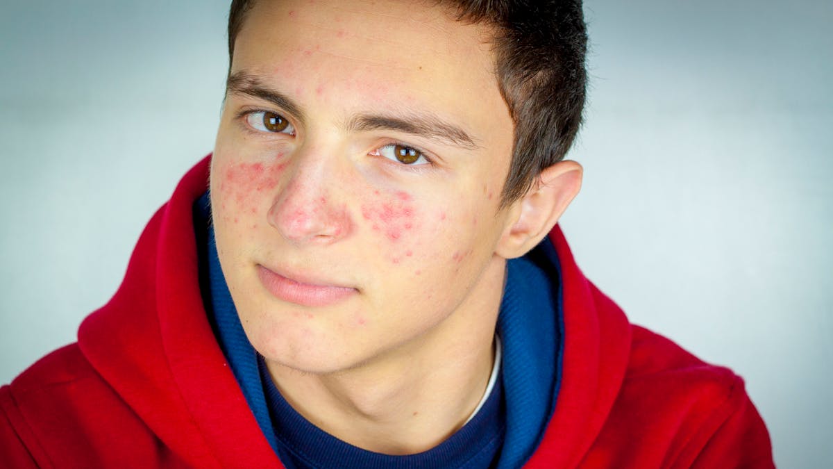 Tout savoir sur l'acné