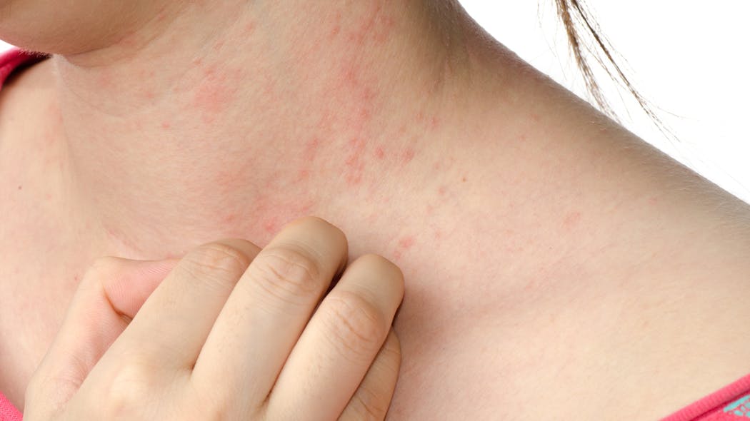 Eczéma de contact:
De forme similaire à l’eczéma constitutionnel, ce dernier apparaît aux endroits de contact avec un allergè