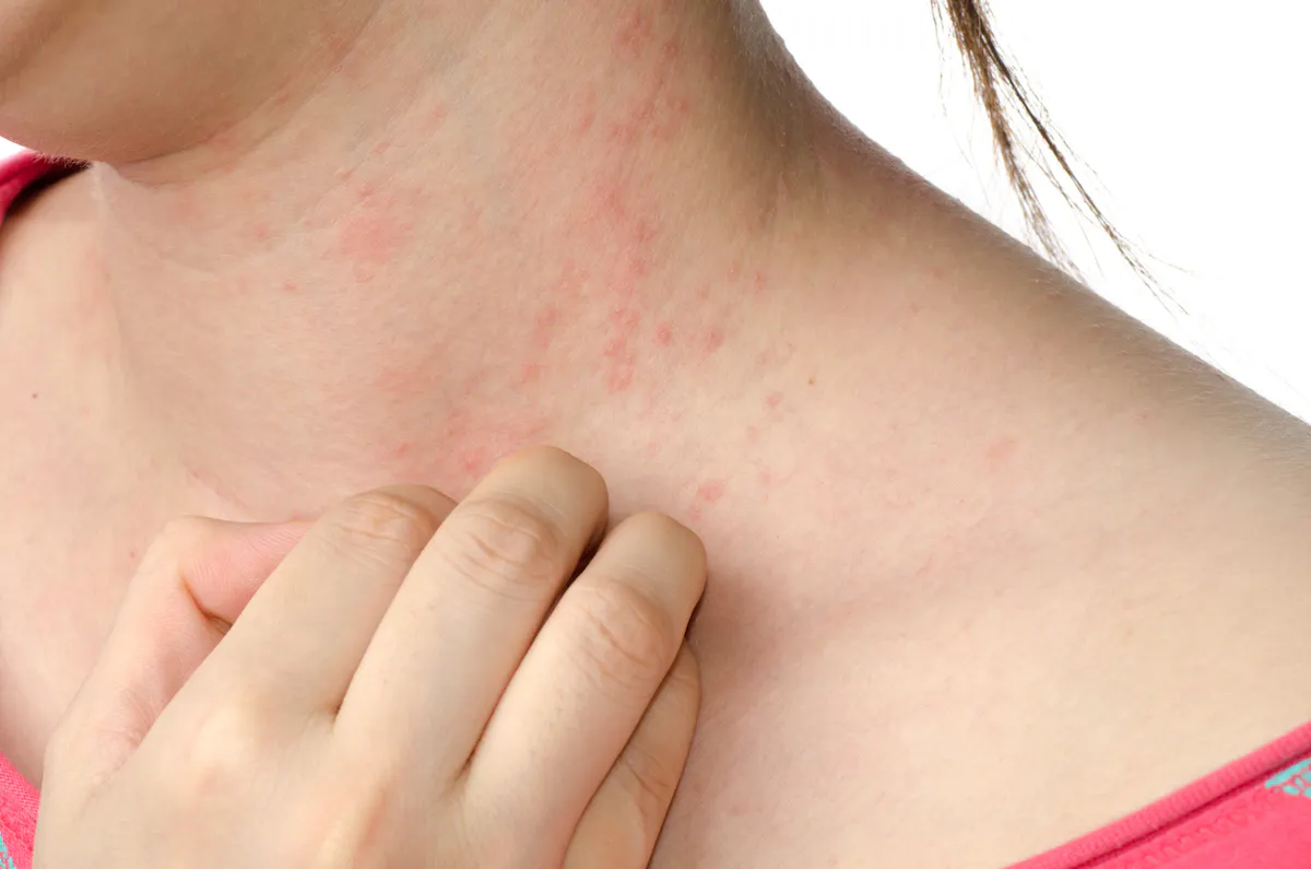 Eczma de contact, eczma allergique : dfinition, causes, symptmes, traitement | Sant Magazine Eczma de contact, eczma allergique : dfinition, causes, symptmes, traitement | Sant Magazine