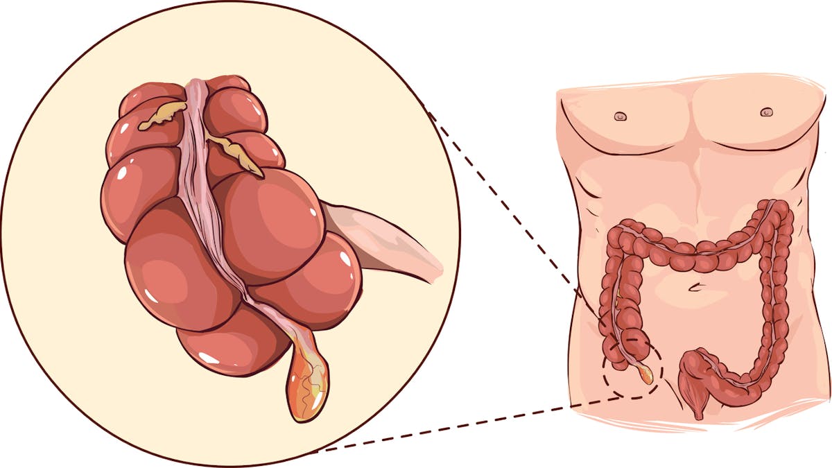 Crise d'appendicite : premiers symptômes, diagnostic, opération | Santé  Magazine