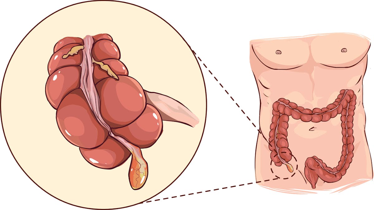 Crise d'appendicite : premiers symptômes, diagnostic, opération ...