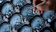 Alzheimer : tout savoir sur cette maladie neurodégénérative