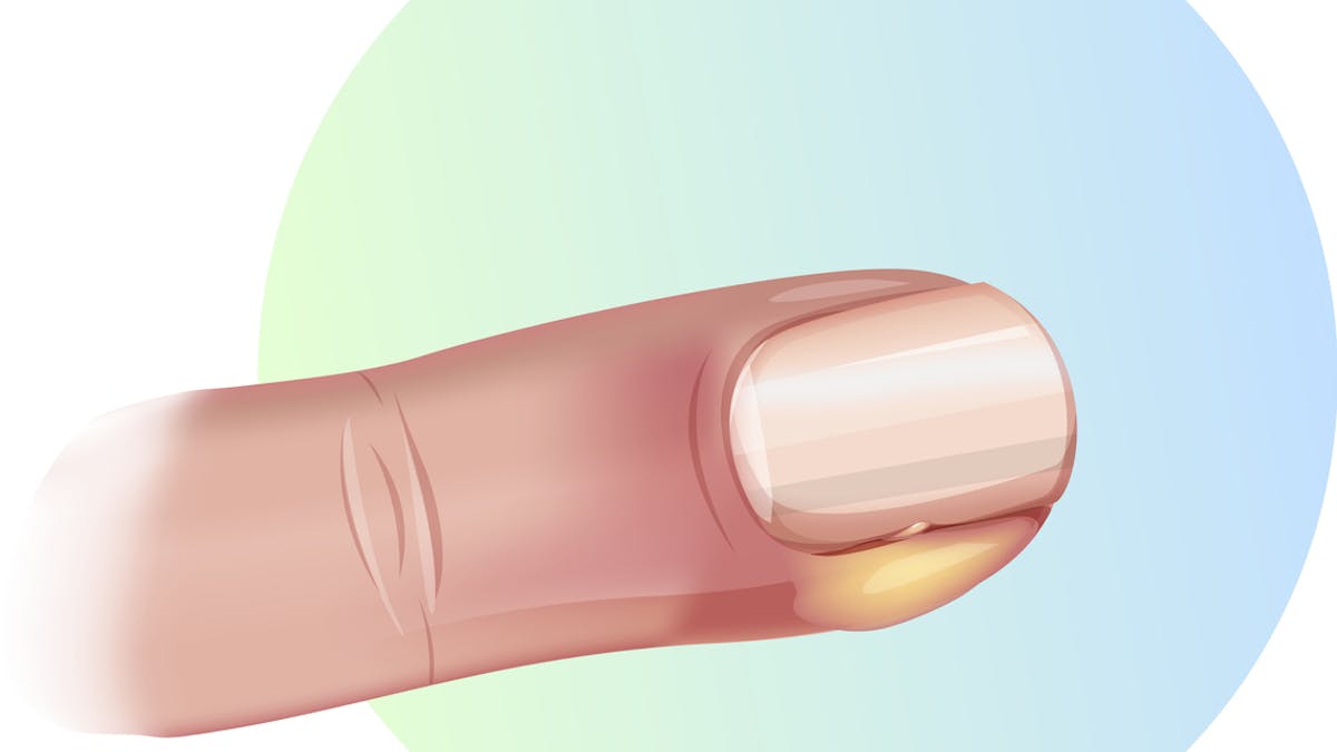 Panaris Au Doigt Main Et Pied Symptomes Comment Soigner Cette Infection Sante Magazine Panaris Au Doigt Main Et Pied Symptomes Comment Soigner Cette Infection Sante Magazine