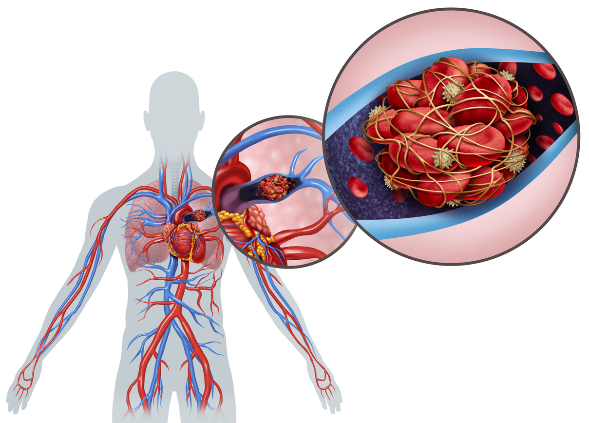 Embolie Pulmonaire : Définition, Symptômes, Traitements | Santé Magazine