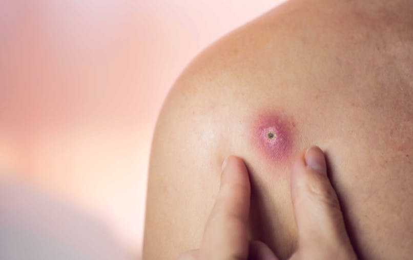 Furoncle Qu Est Ce Que C Est Comment Le Soigner Sante Magazine Furoncle Qu Est Ce Que C Est Comment Le Soigner Sante Magazine