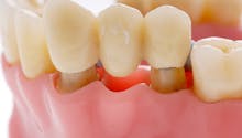 Bridges dentaires : comment préserver les dents saines ?