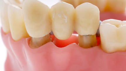 Bridges dentaires : comment préserver les dents saines ?