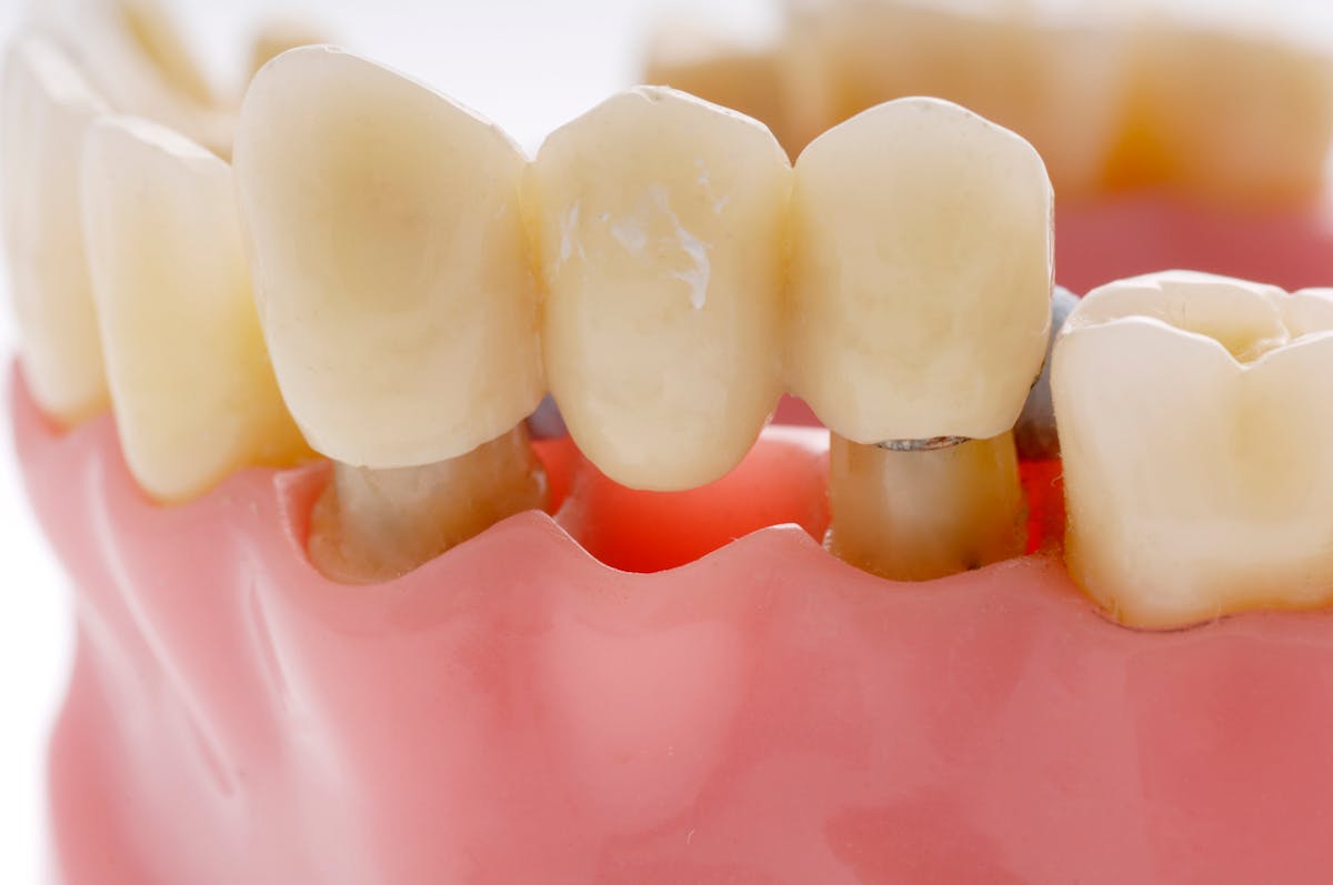 Une patiente toujours insatisfaite du choix de la teinte des dents de sa  prothèse – L'Information Dentaire