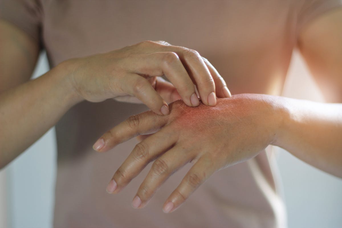 Dyshidrose (mains, pieds...) : symptômes, traitement et prévention ...