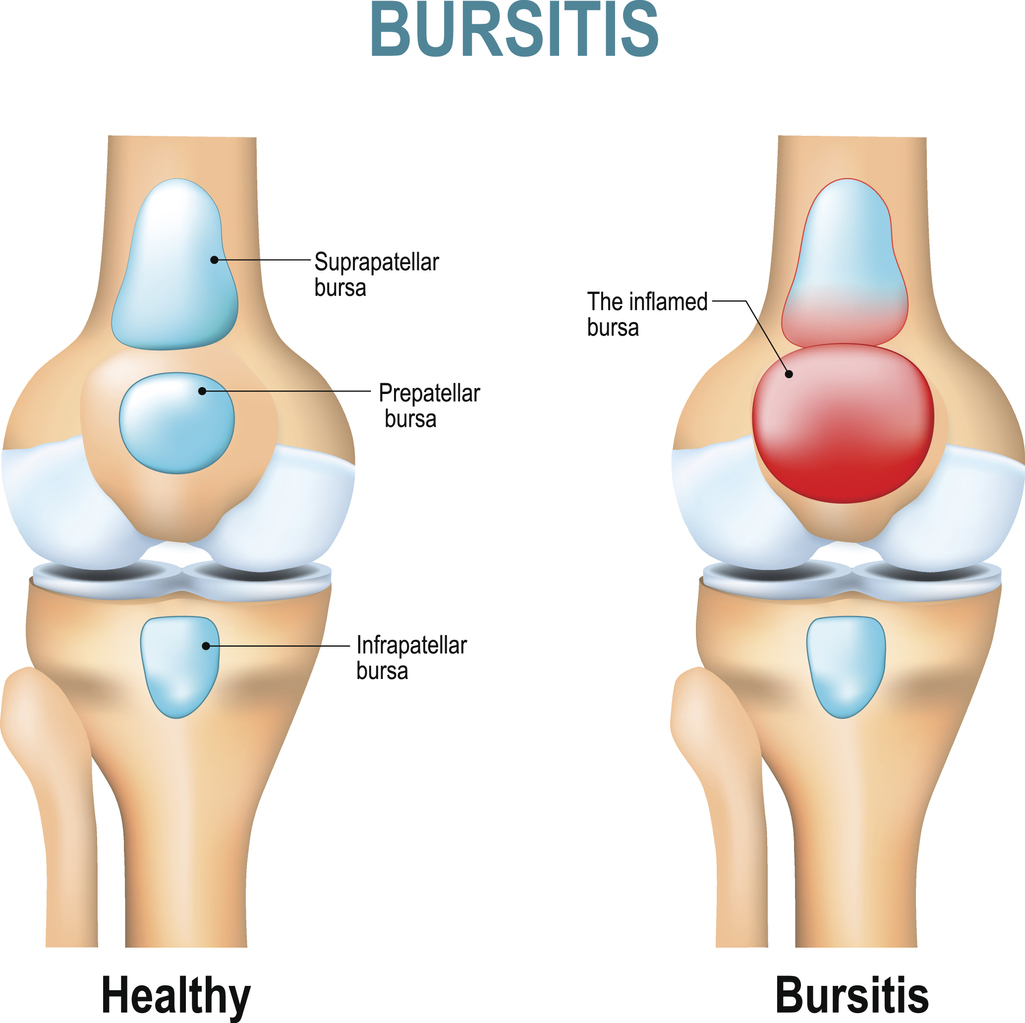 Bursite Definition Causes Symptomes Traitements Sante Magazine