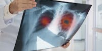 Cancer du poumon : ce qu'il faut savoir