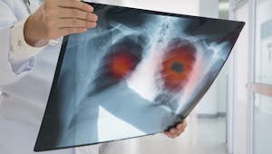 Cancer du poumon, cancer bronchique : ce qu'il faut savoir
