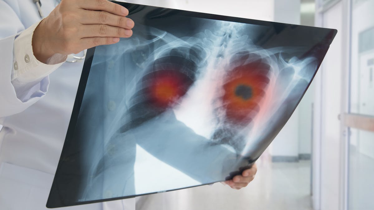 Cancer du poumon : ce qu'il faut savoir