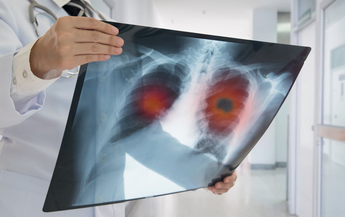 Cancer du poumon : symptômes, prévention, traitements