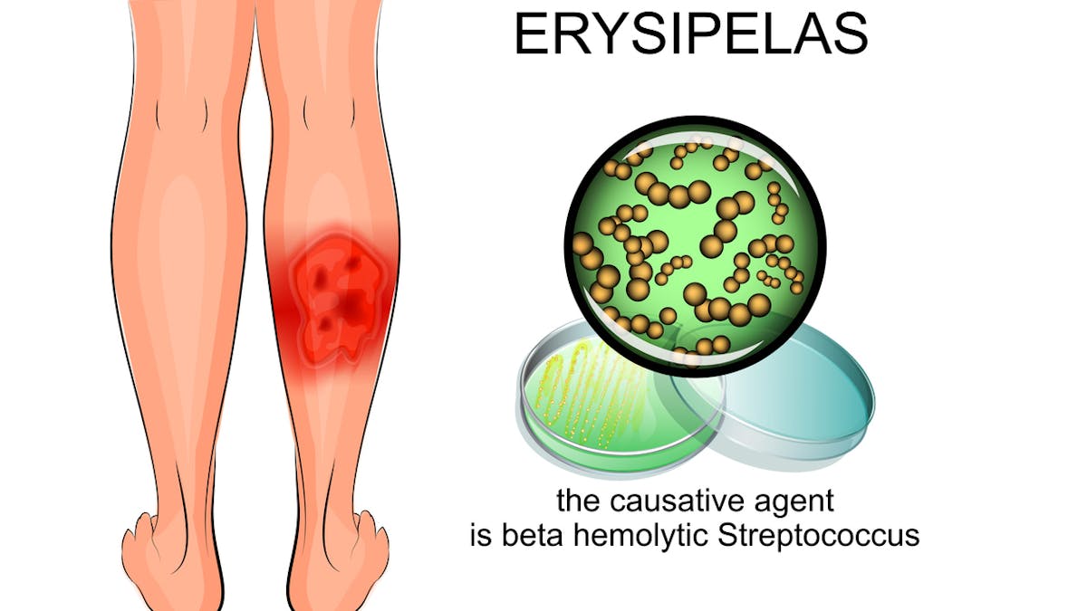 Erysipele Symptomes Causes Et Traitements De Cette Infection De La Peau Sante Magazine Erysipele Symptomes Causes Et Traitements De Cette Infection De La Peau Sante Magazine