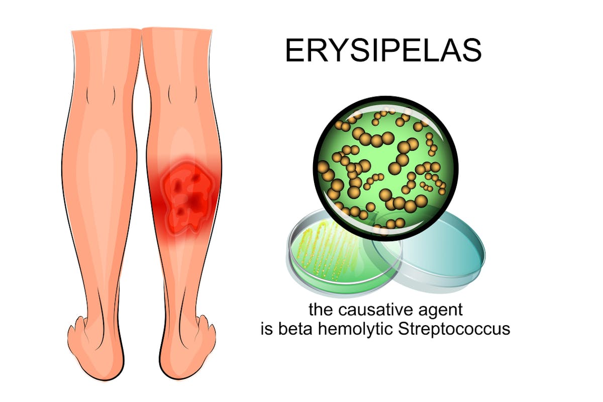 Erysipèle : symptômes, causes et traitements de cette infection de ...