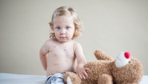Comment reconnaître la rougeole chez le bébé ?