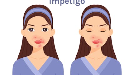 Impétigo : tout savoir sur cette infection bactérienne cutanée