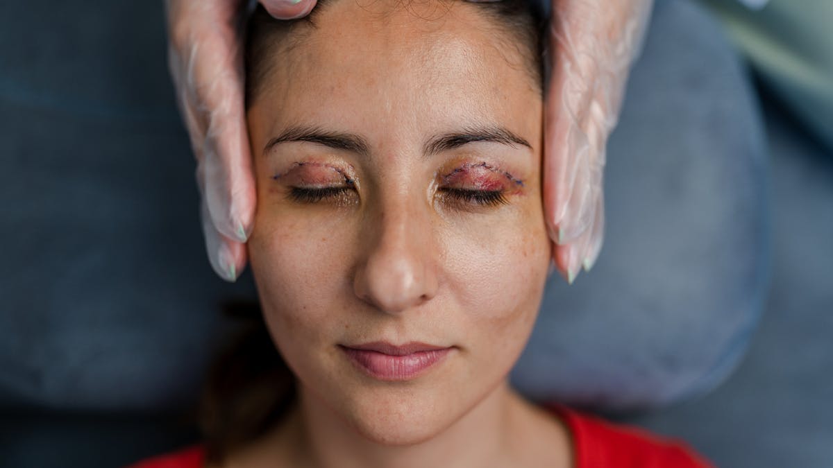 Blepharoplastie Chirurgie Des Paupieres Prix Resultas Risques Sante Magazine Blepharoplastie Chirurgie Des Paupieres Prix Resultas Risques Sante Magazine