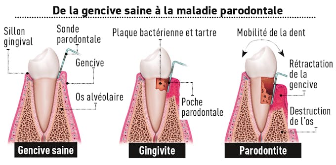 Schéma gencive saine / maladie parodontale 